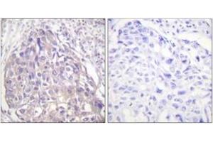 Immunohistochemistry analysis of paraffin-embedded human breast carcinoma, using FOXO1/3/4-pan (Phospho-Thr24/32) Antibody. (FOXO1 antibody  (pThr24))