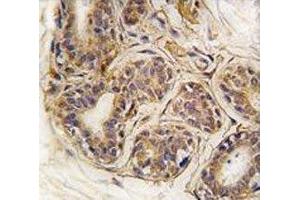 IHC analysis of FFPE human breast carcinoma tissue stained with CASC3 antibody (CASC3 antibody  (AA 159-188))