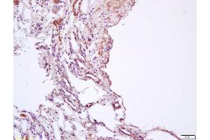 Formalin-fixed and paraffin embedded human lung carcinoma labeled with Anti-phospho-AMPK beta 1 (Ser182) Polyclonal Antibody, Unconjugated (ABIN683068) at 1:200 followed by conjugation to the secondary antibody and DAB staining (PRKAB1 antibody  (pSer182))