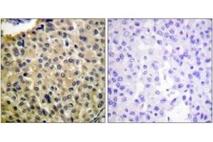 Immunohistochemistry analysis of paraffin-embedded human breast carcinoma, using KIT (Phospho-Tyr703) Antibody. (KIT antibody  (pTyr703))