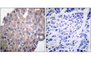 Immunohistochemistry analysis of paraffin-embedded human breast carcinoma, using PLCG1 (Phospho-Tyr771) Antibody. (Phospholipase C gamma 1 antibody  (pTyr771))