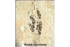 Formalin-fixed and paraffin-embedded human breast carcinoma with ErbB3 Antibody (N-term), which was peroxidase-conjugated to the secondary antibody, followed by DAB staining.