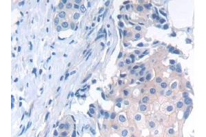 Detection of NCAD in Human Breast cancer Tissue using Polyclonal Antibody to N-cadherin (NCAD) (N-Cadherin antibody  (AA 685-784))