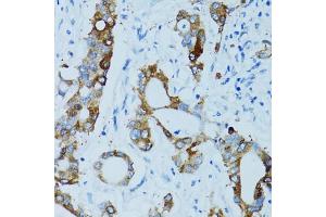 Immunohistochemistry of paraffin-embedded human colon carcinoma using CTSE antibody (ABIN5971444) at dilution of 1/100 (40x lens). (Cathepsin E antibody)