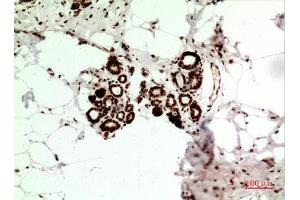 Immunohistochemistry (IHC) analysis of paraffin-embedded Human Breast Cancer, antibody was diluted at 1:100. (HSP70 antibody  (Ser102))