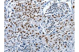 The image on the left is immunohistochemistry of paraffin-embedded Human lung cancer tissue using ABIN7191895(PIWIL3 Antibody) at dilution 1/20, on the right is treated with synthetic peptide. (PIWIL3 antibody)