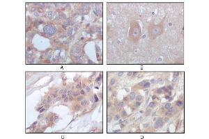 Immunohistochemical analysis of paraffin-embedded human ovary carcinoma (A), normal cerebrum tissues (B), breast infiltrating carcinoma (C) and breast infiltrating carcinoma (D), showing cytoplasmic localization using STYK1/NOK antibody with DAB staining.