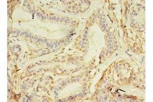 Immunohistochemistry of paraffin-embedded human breast cancer using ABIN7161747 at dilution of 1:100 (NAIF1 antibody  (AA 1-172))