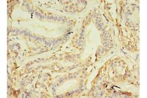 Immunohistochemistry of paraffin-embedded human breast cancer using ABIN7161747 at dilution of 1:100 (NAIF1 antibody  (AA 1-172))