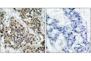 Immunohistochemistry analysis of paraffin-embedded human breast carcinoma, using FKHR (Phospho-Ser256) Antibody. (FOXO1 antibody  (pSer256))