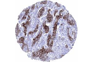 Squamous cell carcinoma with variable Dsg1 staining of tumor cells showing only weak staining at the periphery of tumor cell nests (Desmoglein 1 antibody)