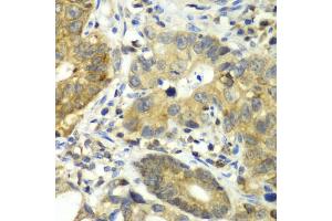 Immunohistochemistry of paraffin-embedded human gastric cancer using DPP3 antibody. (DPP3 antibody)