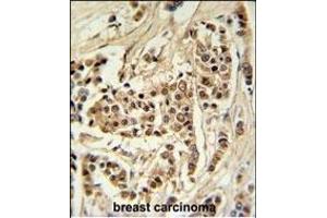TTL Antibody (C-term) (ABIN651357 and ABIN2840199) IHC analysis in formalin fixed and raffin embedded human breast carcinoma followed by peroxidase conjugation of the secondary antibody and DAB staining. (TTPAL antibody  (C-Term))