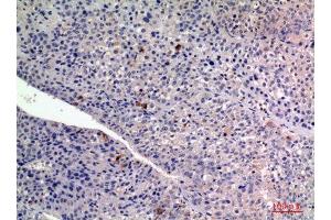 Immunohistochemistry (IHC) analysis of paraffin-embedded Human Liver Cancer, antibody was diluted at 1:100. (FGF2 antibody  (Internal Region))