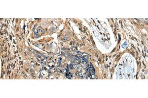 Immunohistochemistry of paraffin-embedded Human esophagus cancer tissue using CAMKK1 Polyclonal Antibody at dilution of 1:35(x200)