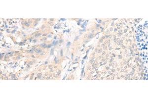 Immunohistochemistry of paraffin-embedded Human cervical cancer tissue using AOAH Polyclonal Antibody at dilution of 1:25(x200) (AOAH antibody)