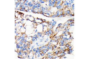 Immunohistochemistry of paraffin-embedded human oophoroma using AIF antibody (ABIN7265648) at dilution of 1:100 (40x lens).