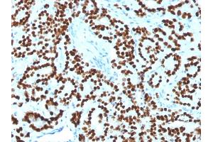 Formalin-fixed, paraffin-embedded human Prostate Carcinoma stained with FOXA1 Monoclonal Antibody (FOXA1/1518).