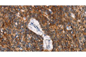 Immunohistochemistry of paraffin-embedded Human lung cancer tissue using CD68 Polyclonal Antibody at dilution 1:30 (CD68 antibody)