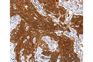Immunohistochemistry of Human esophagus cancer using HOXB1 Polyclonal Antibody at dilution of 1:40