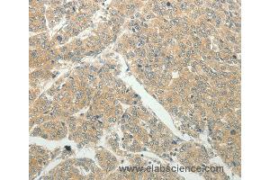 Immunohistochemistry of Human liver cancer using SLC8A3 Polyclonal Antibody at dilution of 1:50 (SLC8A3 antibody)