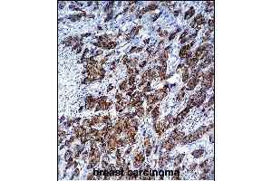 LGALS3 Antibody (C-term) (ABIN1536595 and ABIN2843799) immunohistochemistry analysis in formalin fixed and paraffin embedded human breast carcinoma followed by peroxidase conjμgation of the secondary antibody and DAB staining. (Galectin 3 antibody  (C-Term))