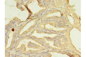 Immunohistochemistry of paraffin-embedded human prostate cancer using ABIN7169587 at dilution of 1:100 (SFXN2 antibody  (AA 1-99))