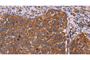 Immunohistochemistry of paraffin-embedded Human cervical cancer tissue using FBXW7 Polyclonal Antibody at dilution 1:40 (FBXW7 antibody)