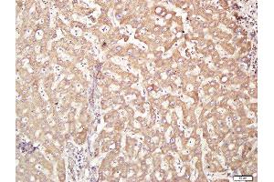 Paraformaldehyde-fixed, paraffin embedded human hepatocellular carcimona tissue, Antigen retrieval by boiling in sodium citrate buffer(pH6) for 15min, Block endogenous peroxidase by 3% hydrogen peroxide for 30 minutes, Blocking buffer (normal goat serum) at 37°C for 20min, Antibody incubation with Rabbit Anti-ACCN4 Polyclonal Antibody, Unconjugated  at 1:300 overnight at 4°C, followed by a conjugated secondary and DAB staining (ACCN4 antibody  (AA 451-550))