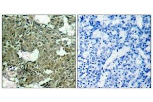 Immunohistochemical analysis of paraffin-embedded human breast carcinoma tissue using MEK1(Phospho-Ser221) Antibody(left) or the same antibody preincubated with blocking peptide(right). (MEK1 antibody  (pSer221))