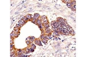 Immunohistochemical analysis of paraffin-embedded human colorectal carcinoma section using PCSK9 antibody (PCSK9 antibody  (AA 144-173))