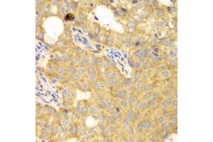 Immunohistochemistry of paraffin-embedded human oophoroma using GNB2L1 antibody at dilution of 1:100 (400x lens). (GNB2L1 antibody)