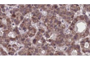 ABIN6273904 at 1/100 staining Human liver cancer tissue by IHC-P. (LPAR5 antibody  (Internal Region))