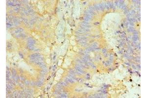 Immunohistochemistry of paraffin-embedded human colon cancer using ABIN7154050 at dilution of 1:100