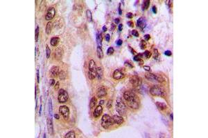 Immunohistochemical analysis of AMPK alpha 1/2 (pT183/172) staining in human lung cancer formalin fixed paraffin embedded tissue section. (PRKAA1/PRKAA2 antibody  (pSer172, pSer183))