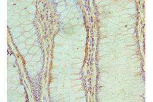 Immunohistochemistry of paraffin-embedded human colon cancer using ABIN7143717 at dilution of 1:100 (ALKBH1 antibody  (AA 110-389))