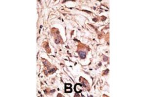 Formalin-fixed and paraffin-embedded human cancer tissue reacted with the primary antibody, which was peroxidase-conjugated to the secondary antibody, followed by DAB staining. (MAGED1 antibody  (AA 426-456))