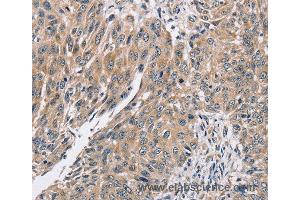 Immunohistochemistry of Human lung cancer using PPP1CC Polyclonal Antibody at dilution of 1:40 (PPP1CC antibody)