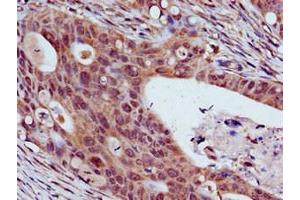 Immunohistochemistry of paraffin-embedded human colon cancer using ABIN7172051 at dilution of 1:100
