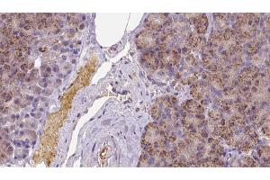 ABIN6273258 at 1/100 staining Human pancreas cancer tissue by IHC-P. (KCTD12 antibody  (Internal Region))