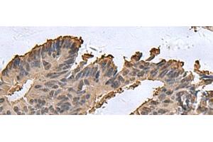 Immunohistochemistry of paraffin-embedded Human colorectal cancer tissue using DCTPP1 Polyclonal Antibody at dilution of 1:85(x200) (DCTPP1 antibody)