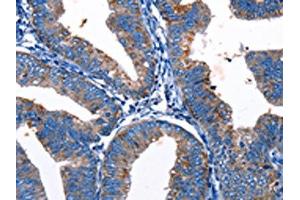 The image on the left is immunohistochemistry of paraffin-embedded Human cervical cancer tissue using ABIN7193124(Gjc3 Antibody) at dilution 1/10, on the right is treated with synthetic peptide. (GJC3 antibody)