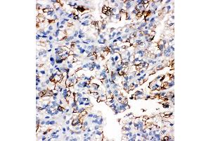 Anti-Aquaporin 1 antibody, IHC(P) IHC(P): Human Kidney Cancer Tissue (Aquaporin 1 antibody  (C-Term))