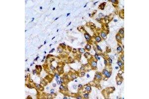 Immunohistochemical analysis of SCP2 staining in human liver cancer formalin fixed paraffin embedded tissue section. (SCP2 antibody)