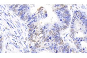 Detection of NPM1 in Human Colorectal cancer Tissue using Polyclonal Antibody to Nucleophosmin 1 (NPM1) (NPM1 antibody  (AA 20-154))