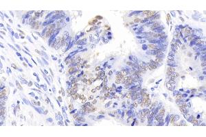 Detection of NPM1 in Human Colorectal cancer Tissue using Polyclonal Antibody to Nucleophosmin 1 (NPM1) (NPM1 antibody  (AA 20-154))