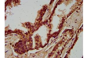 IHC image of ABIN7166221 diluted at 1:200 and staining in paraffin-embedded human prostate cancer performed on a Leica BondTM system. (IGSF9 antibody  (AA 132-298))