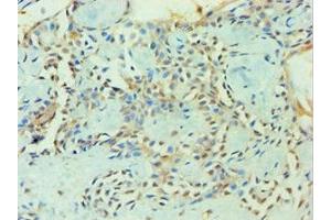 Immunohistochemistry of paraffin-embedded human breast cancer using ABIN7176252 at dilution of 1:100 (ZNF346 antibody  (AA 1-294))
