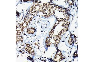 Immunohistochemistry of paraffin-embedded human breast cancer using SUFU Rabbit pAb (ABIN6133029, ABIN6148692, ABIN6148694 and ABIN6217424) at dilution of 1:100 (40x lens). (SUFUH antibody  (AA 325-484))