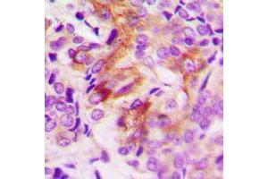 Immunohistochemical analysis of ANGPTL7 staining in human breast cancer formalin fixed paraffin embedded tissue section. (ANGPTL7 antibody  (C-Term))